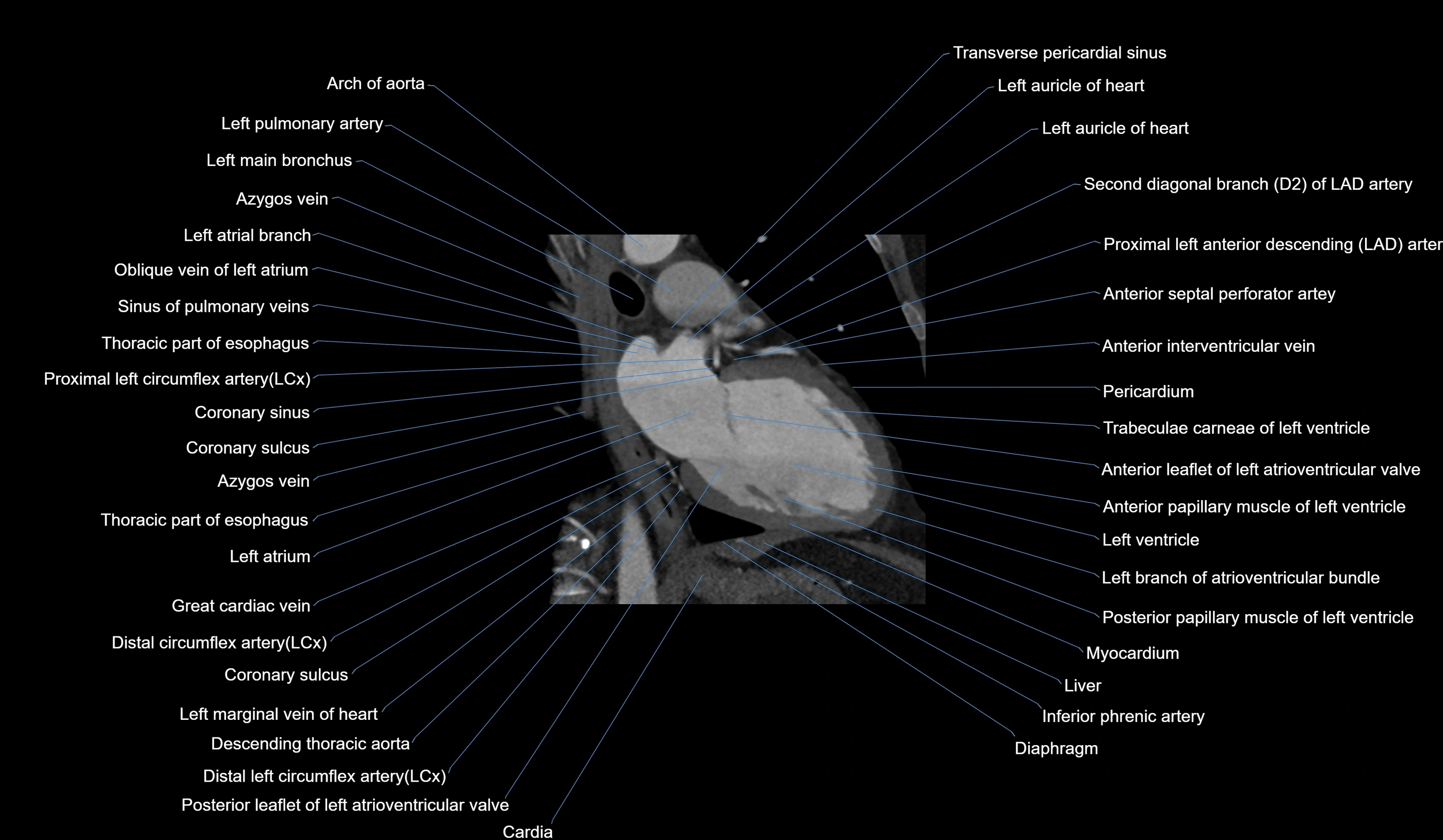 CT heart (coronary angiogram) 2 chamber view cross sectional anatomy labelled radiology image-00014.webp